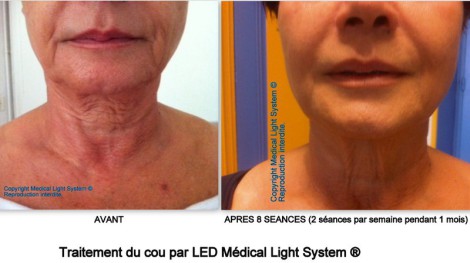 Traitement du rajeunissement et du raffermissement du cou par LED Médical Light System® Mme A.....