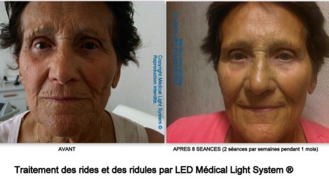 Traitement des rides et des ridules sur peau mature, par LED Médical Light System®