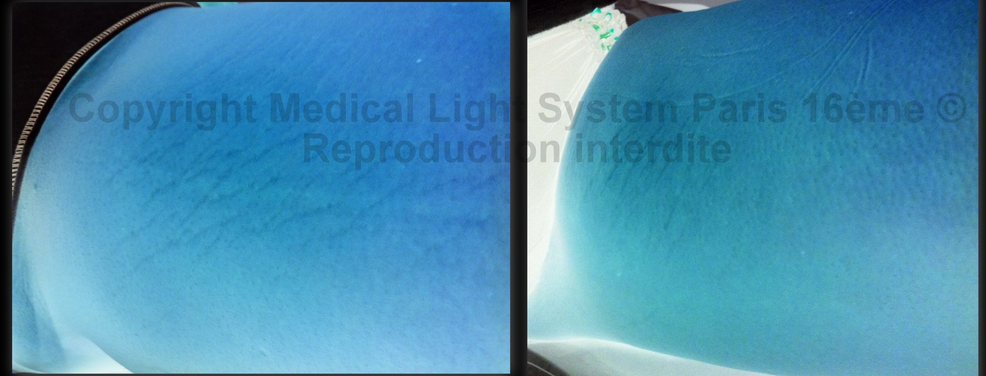 photos vergeture peau mate avant apres avec Vu en relief - traitement par LED Médical Light System Paris 16ème © Melle AU.....