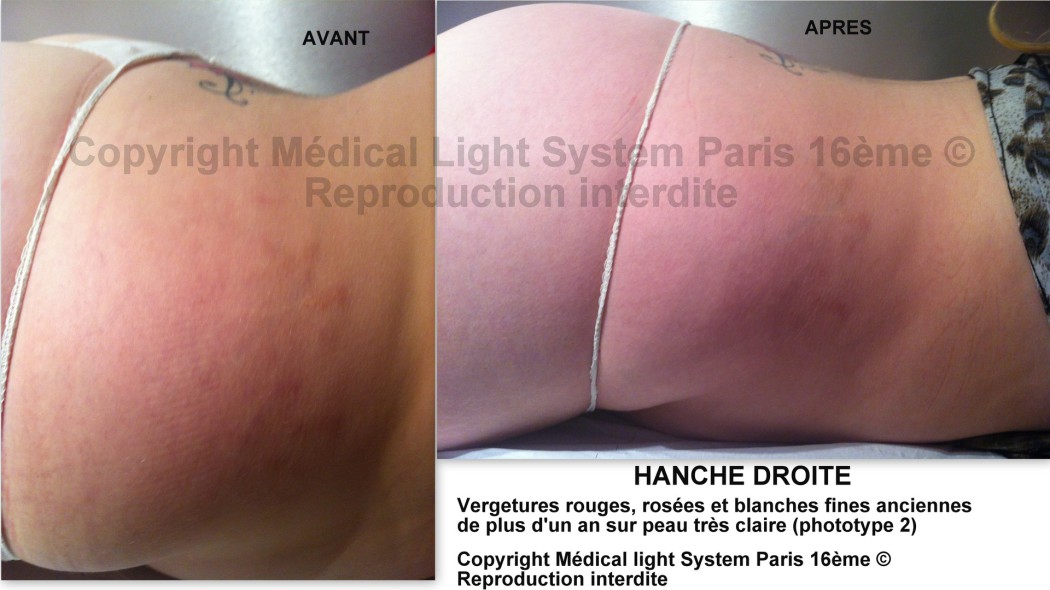 photos vergetures sur fessier peau mate avant apres - Copyright Medical Light System Paris 16ème © Melle P.....