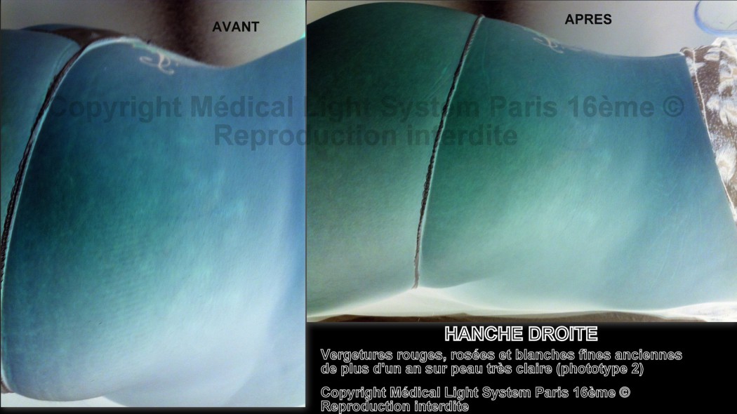 photos vergetures sur hanche peau très claire avant apres avec vu en relief - Copyright Medical Light System Paris 16ème © Melle P.....