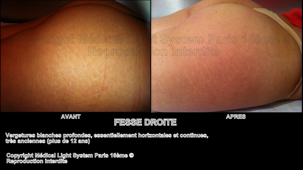 photos vergetures peau noire sur fesse avant apres - Copyright Medical Light System Paris 16ème © Mme SA.....