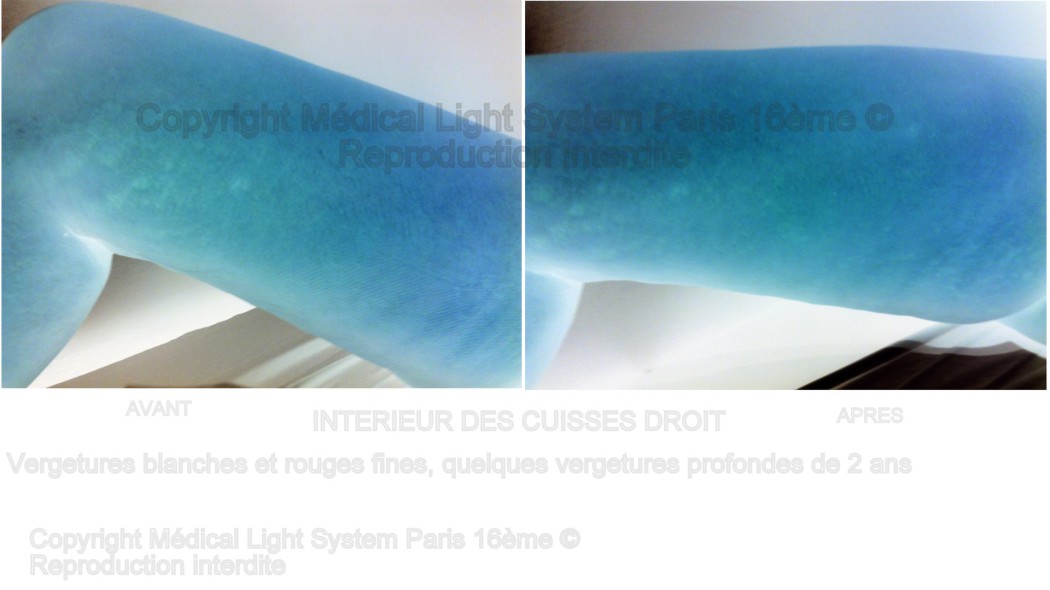 photos vergetures sur intérieur des cuisses peau foncée avant apres avec vu en relief - soins par LED Medical Light System Paris 16ème © Melle L.....