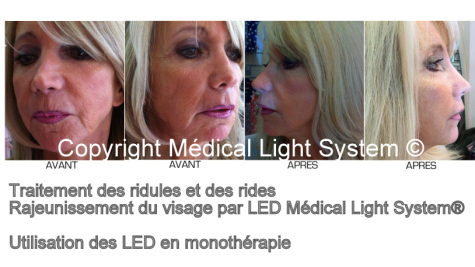 Traitement du rajeunissement et du raffermissement du visage et des rides par LED Médical Light System®