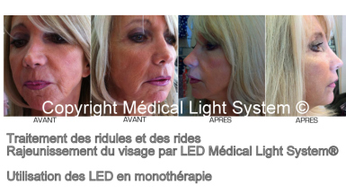 Amélioration et traitement par LED Médical Light System®