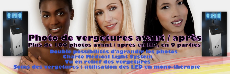 Photo de vergetures avant après (4ème partie), traitement par LED Médical Light System® centre Pilote ©